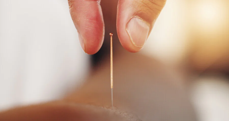 Quels sont les bienfaits de l'acupuncture pour réduire le stress ?